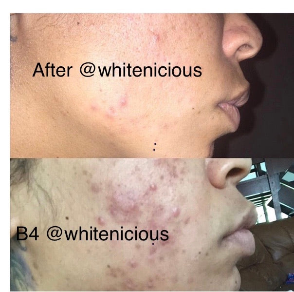 Acne Be Gone Face Set. Blac Chyna