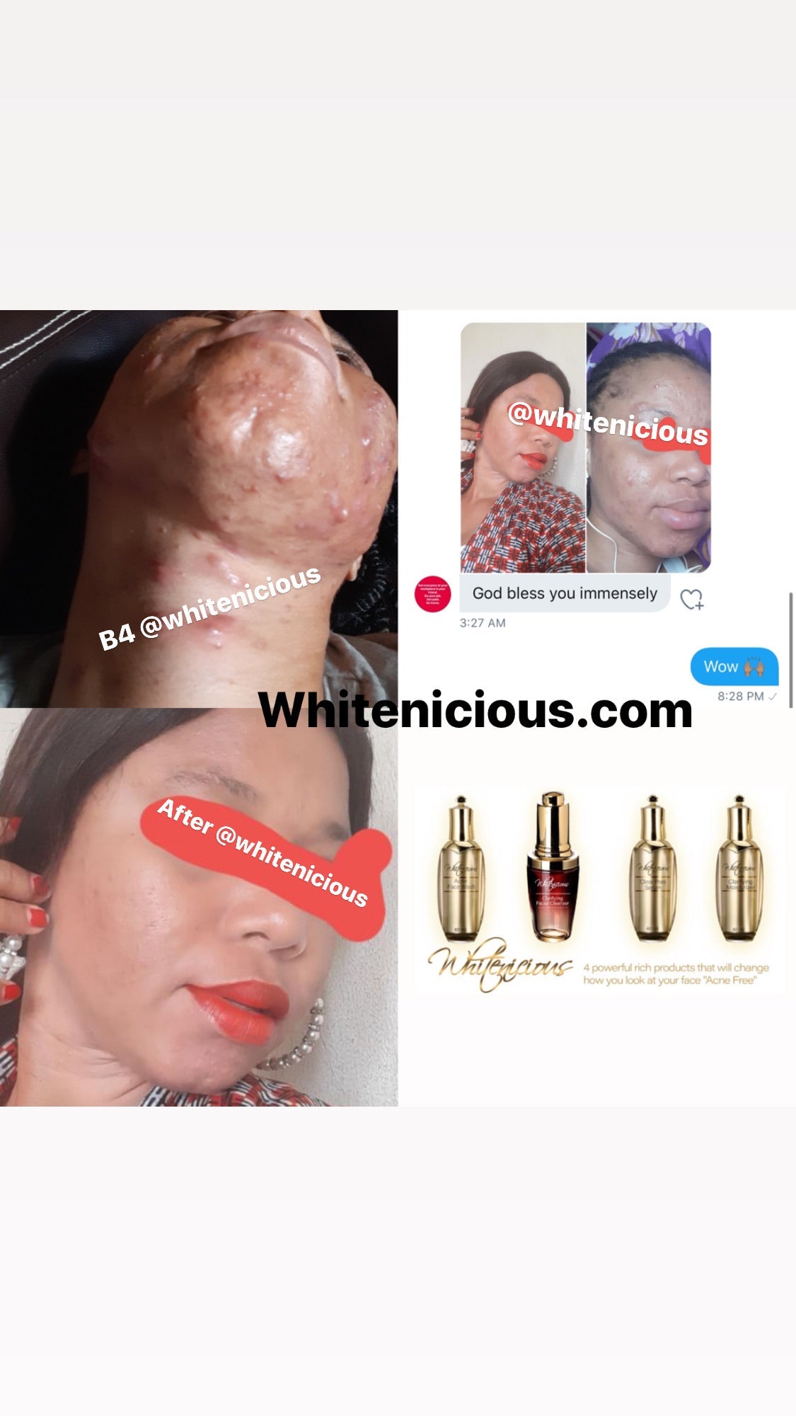Acne Be Gone Face Set. Blac Chyna