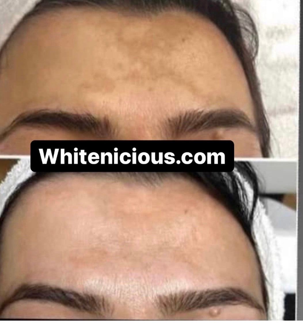 MELASMA RESCUE