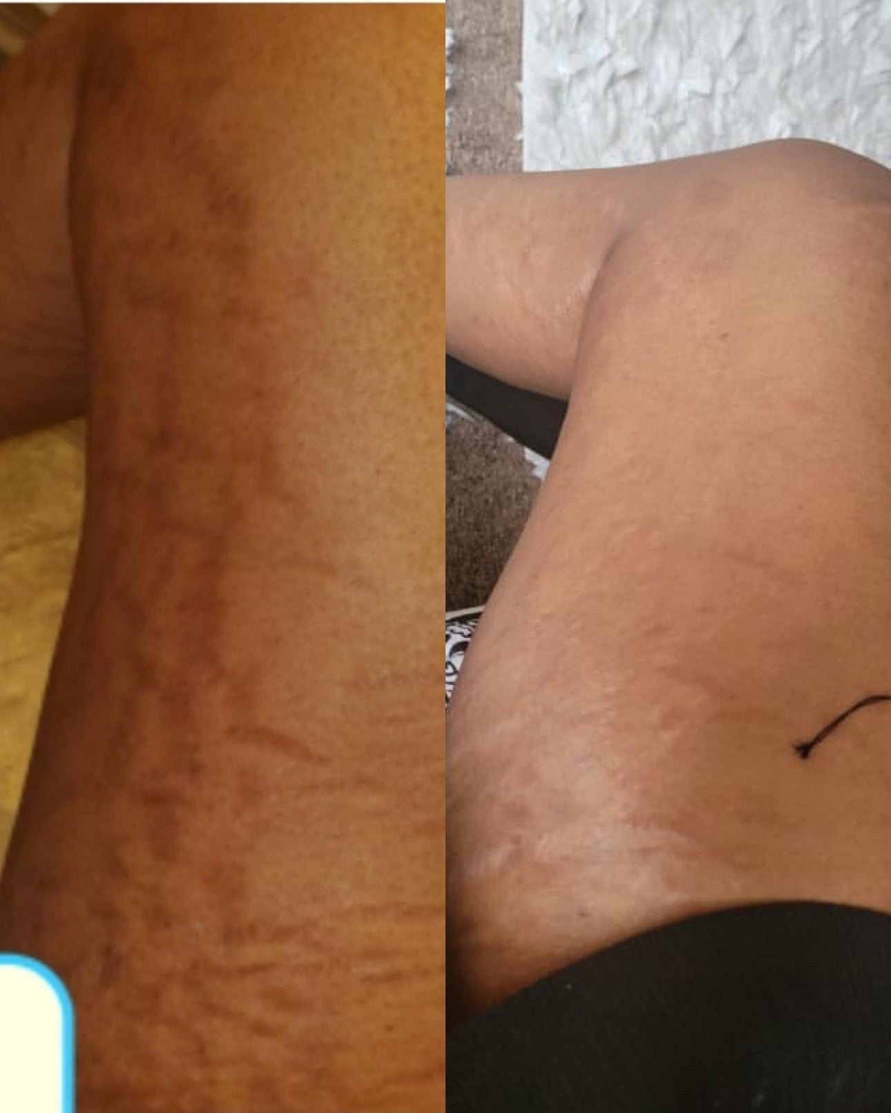 SCARING (SURGERY, OLD, & BURN MARKS)
