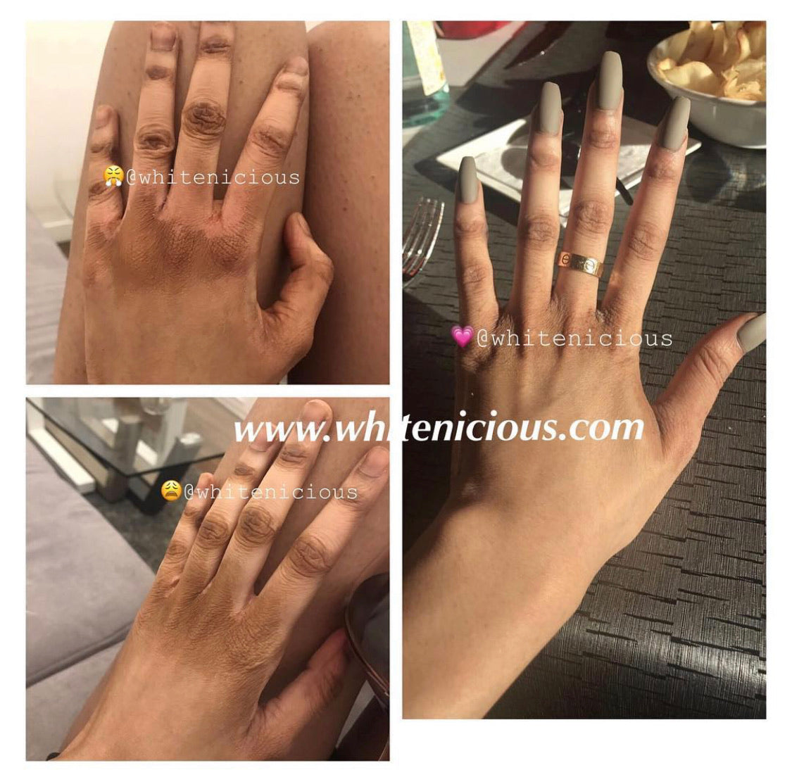 Dark Knuckles Cream | Snow White Knuckles Cream | Whitenicious