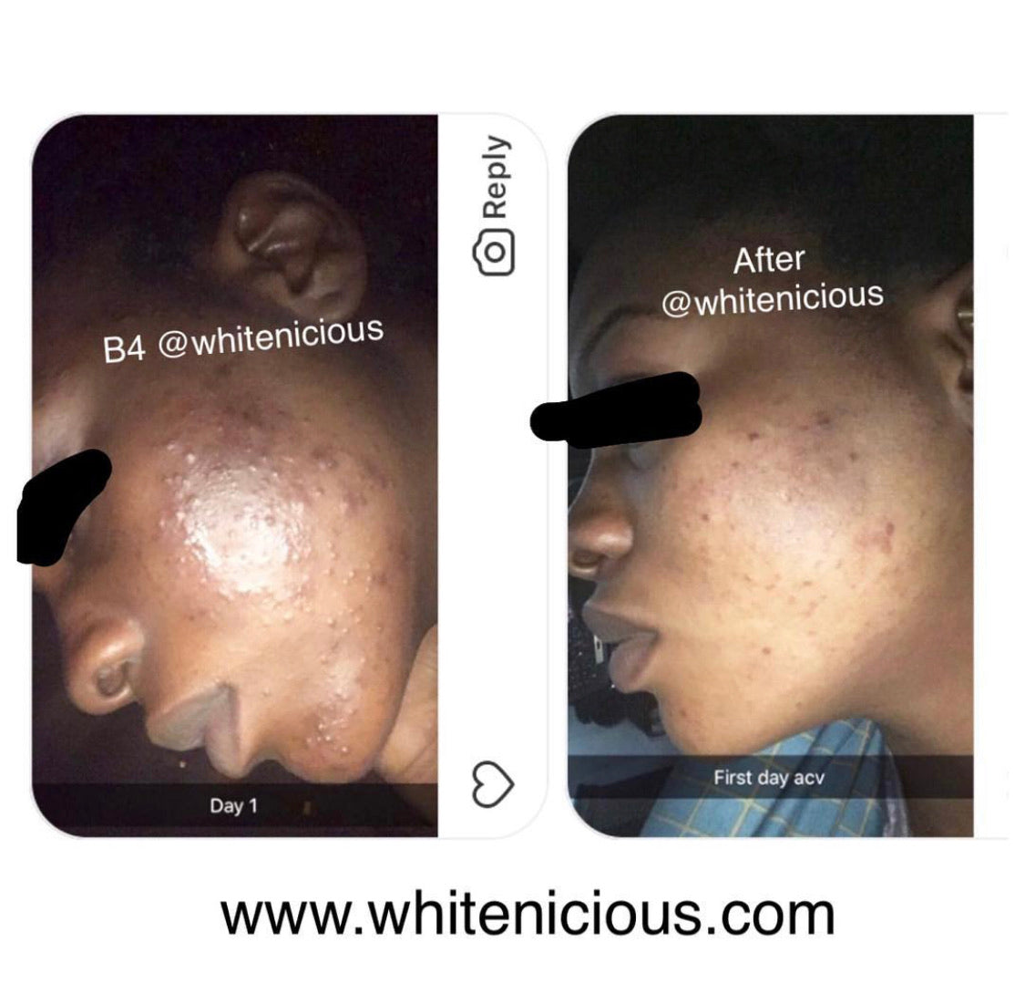 Ngwọta ọgwụgwọ ACNE ERASER